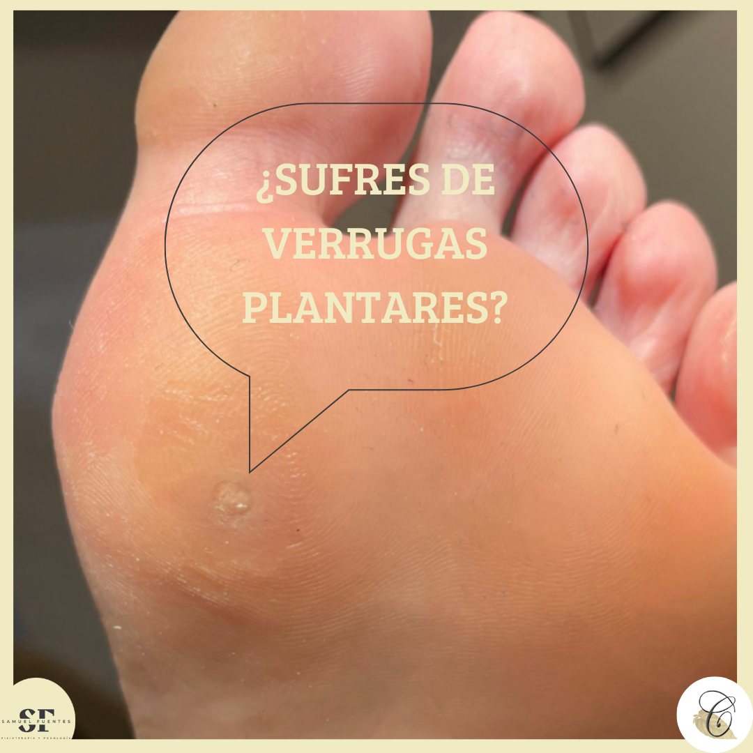 Todo lo que necesitas saber sobre las verrugas plantares