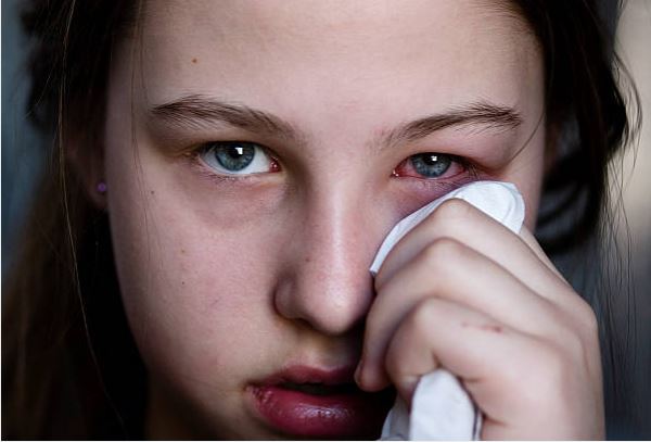 Conjuntivitis Vernal.
